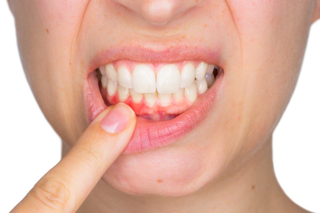 牙周病 Periodontal disease