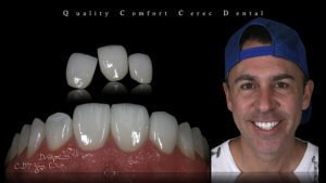3D齒雕技術,牙齒診療體驗,3D齒雕