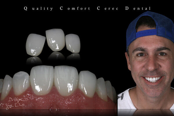 3D齒雕技術,牙齒診療體驗,3D齒雕