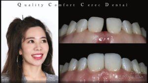 品適牙醫 高雄牙醫推薦 3D陶瓷貼片 3D全瓷牙