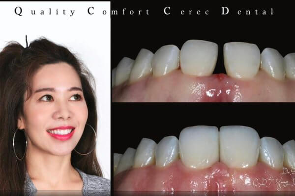 品適牙醫 高雄牙醫推薦 3D陶瓷貼片 3D全瓷牙