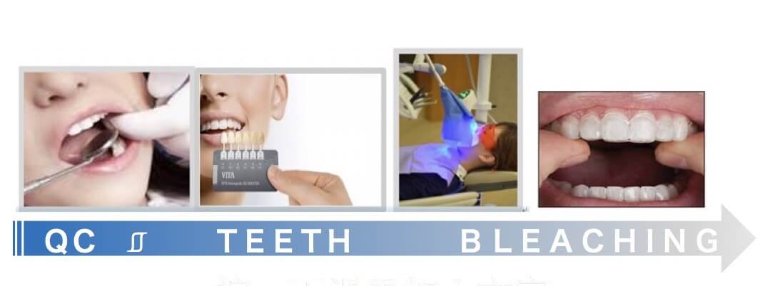 高品質的瓷牙貼片牙齒美白療程 一日美齒 牙齒美白‎