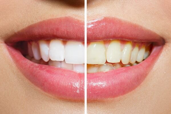 牙齒美白流程不馬虎，讓專業的來才能最放心！