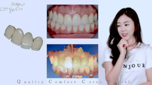 高雄CEREC 3D齒雕一日美牙技術