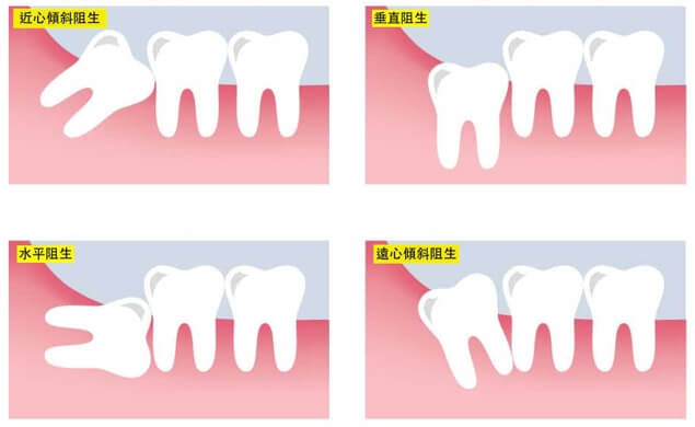 Ｑ.智齒是怎麼拔除？ 智齒的阻生型態有很多種，臨床上主要是這四種：