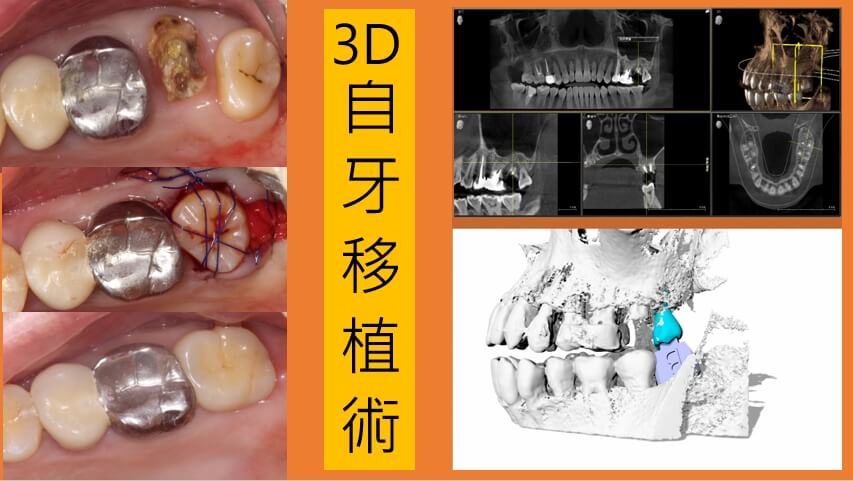 什麼是3D自牙移植術？ 3D自牙移植術(自體牙齒移植)