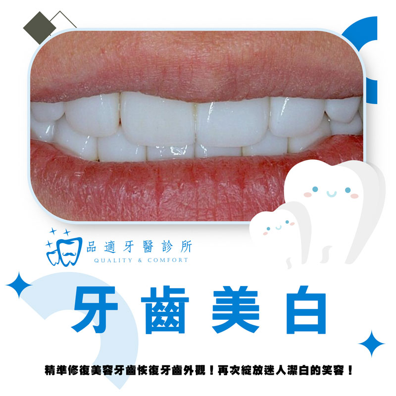 牙齒美白療程介紹