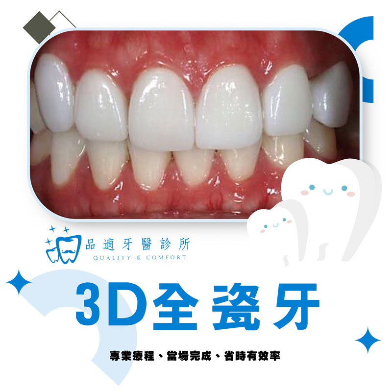 3D全瓷牙技術介紹