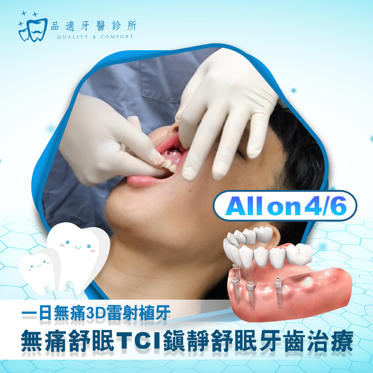 All-on-4 / 5 / 6 全口植牙重建介紹